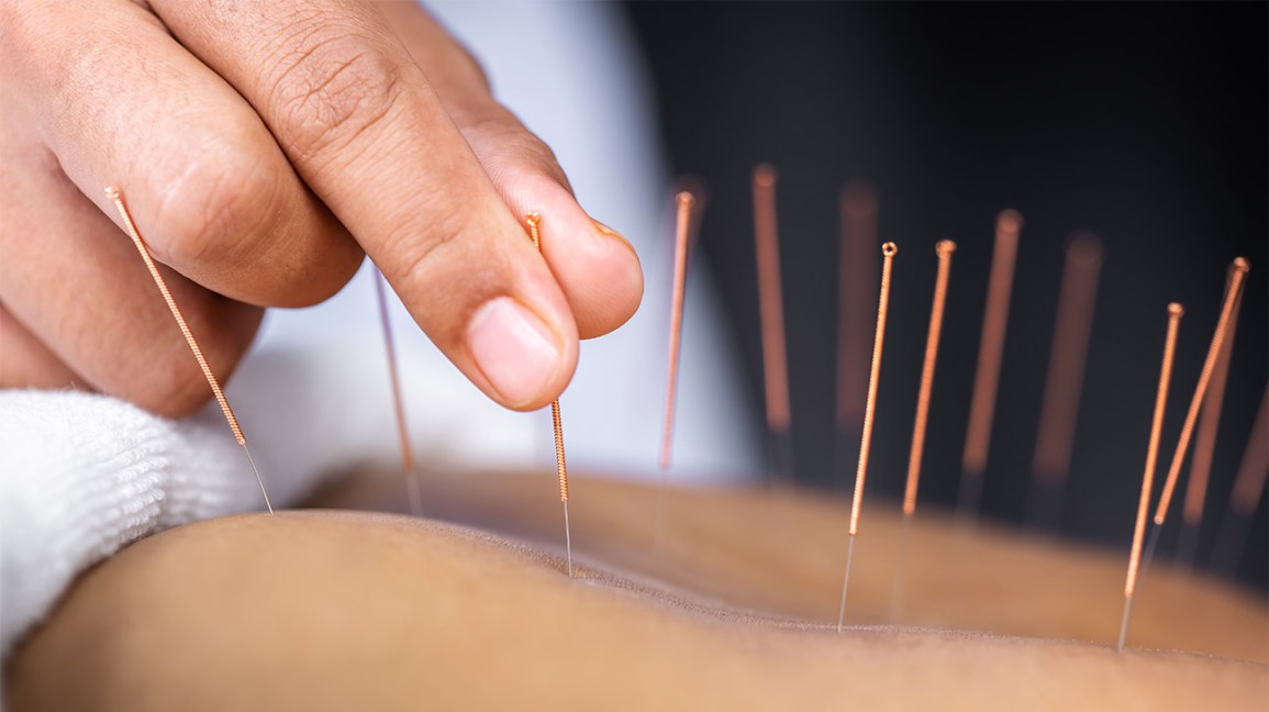 Acupuncture therapy in pune